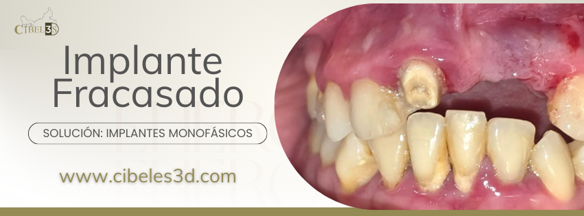 Análisis de Caso Clínico: Rehabilitación de Implante Fracasado solución con Técnica Córticobasal Monofásica en Zona Anterosuperior