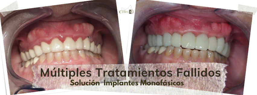 Caso Clínico: Implantes Monofásicos en Arcada Superior con Múltiples Tratamientos Fallidos