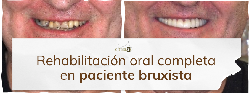 Caso clínico: Rehabilitación oral completa en paciente bruxista con Implantología Estratégica Corticobasal
