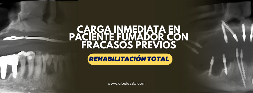 Manejo Clínico de Paciente Fumador con Periodontitis Avanzada: Protocolo para Implantología Monofásica