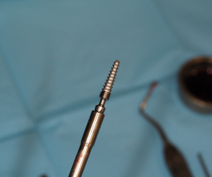 cada caso es distinto y hay que saber elegir bien. curso implante dental