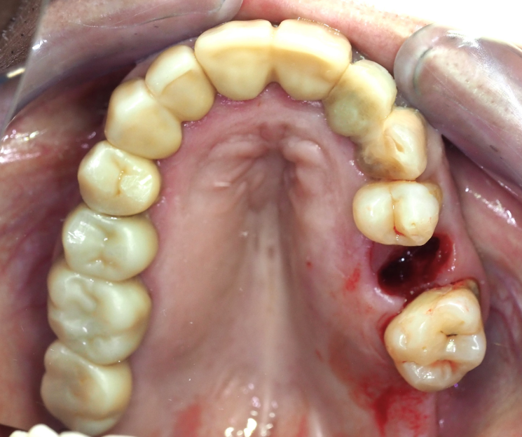 con buena estabilidad se puede cargar el implante de forma inmediata curso implantología