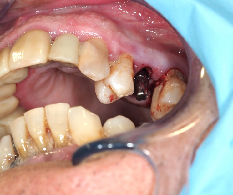 curso en cibeles3d, con el dr. francisco díez, se aprende a elegir bien cada caso