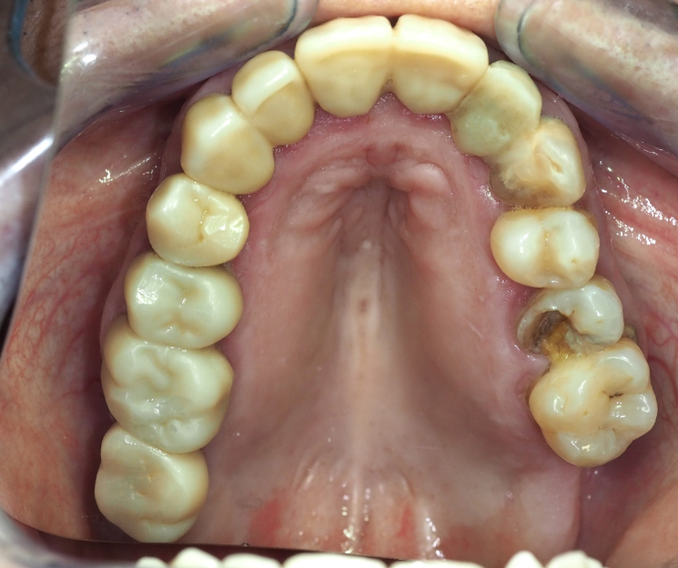 el diente 25 se extrajo y se puso un implante el mismo día