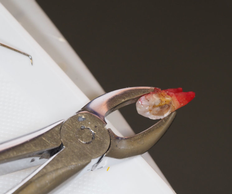 este implante compacta el hueso y da mucha sujeción desde el primer momento