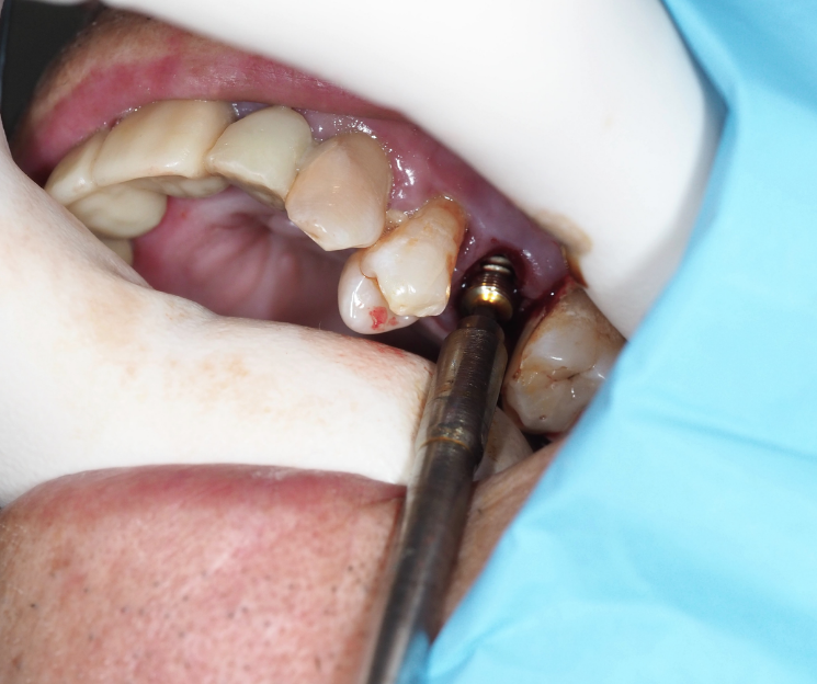 la clave está en la formación y en estar al día. implantología monofásica