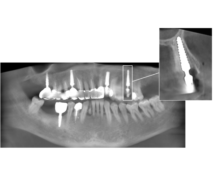 la meta es clara rehabilitar pronto y no dejar al paciente sin dientes. curso implantología