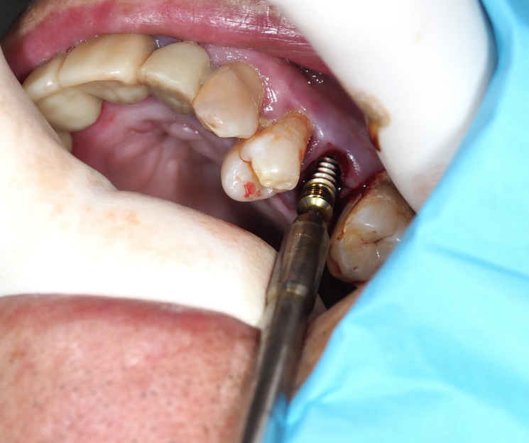 no vale usar un solo tipo de implante para todos. curso implantologia