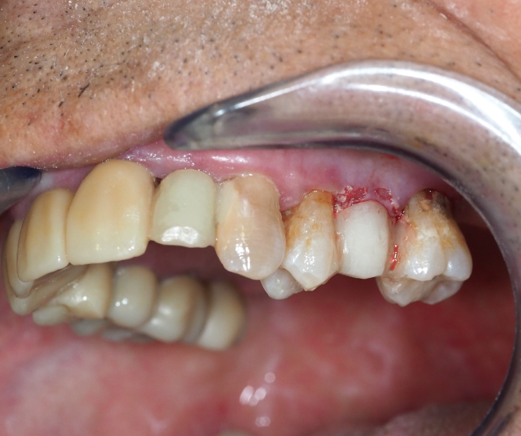 saber cuándo usar un implante compresivo es parte de hacer bien el trabajo. curso implantes dentales