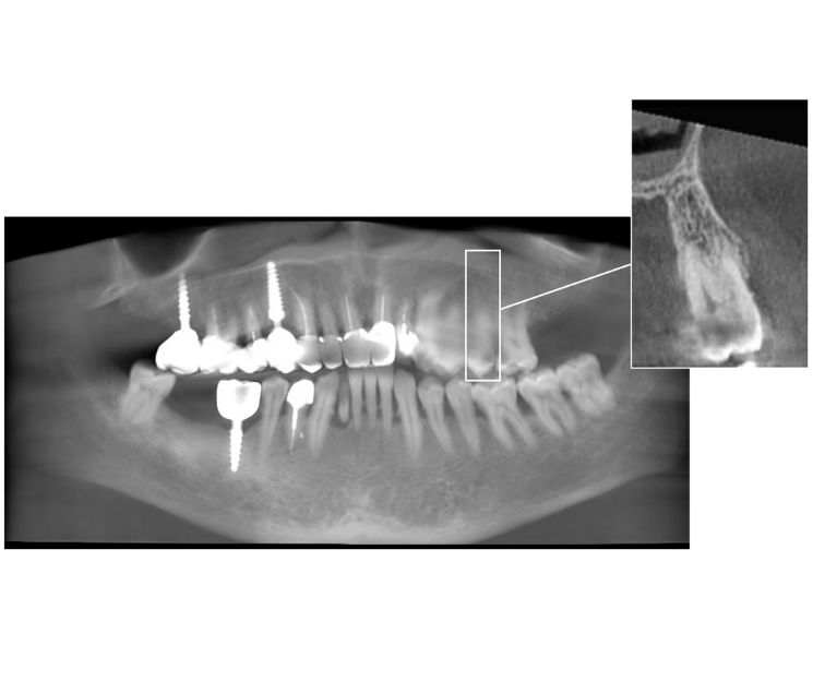 se eligió un implante compresivo por tener hueso sano y de buen volumen