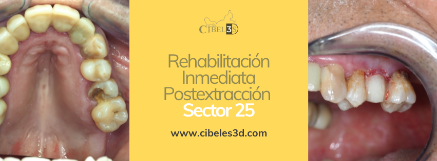 Caso Clínico: Rehabilitación Inmediata Postextracción con Implante Monofásico Compresivo en el sector 25