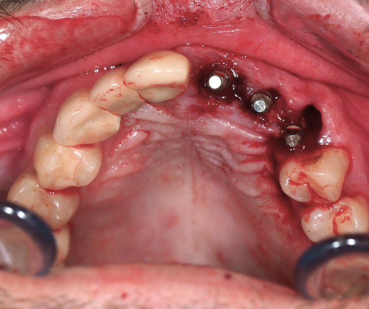 capacitación en implantología cdmx