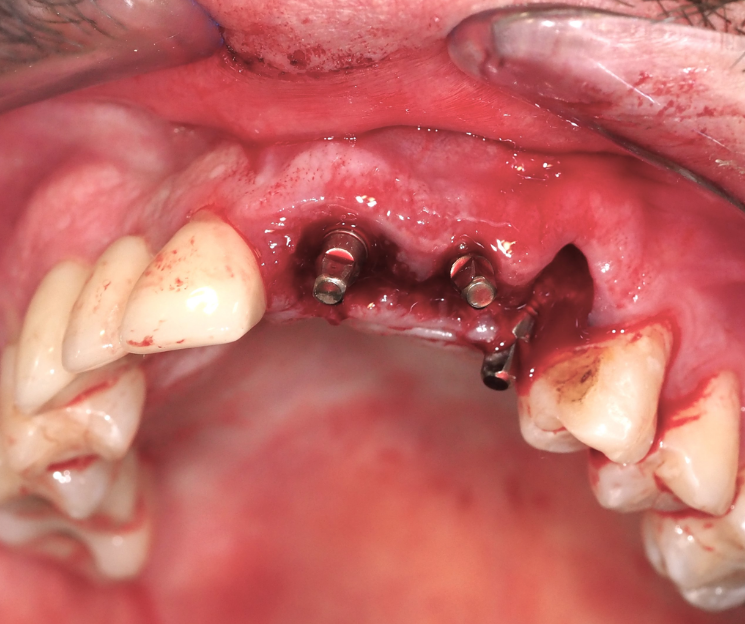 curso de implantes con carga inmediata, con el dr. francisco díez, se aprende a elegir bien cada caso