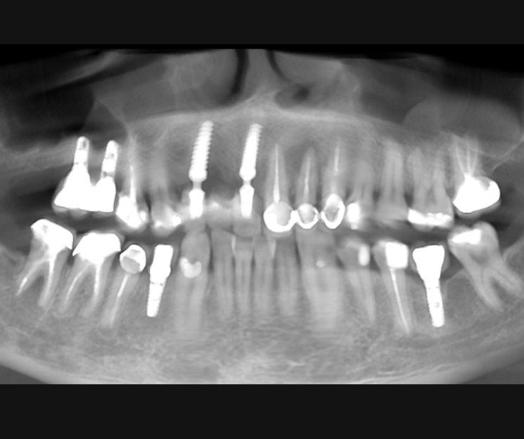 curso de implantes dentales méxico cibeles 3d