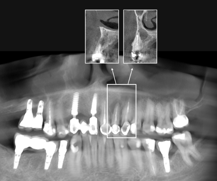 curso de implantología avanzada méxico