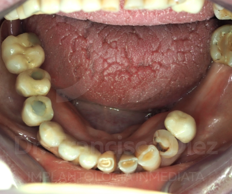 curso implantes el paciente no pasó ni un día sin diente