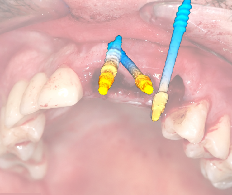 cursos de implantología dental en cdmx