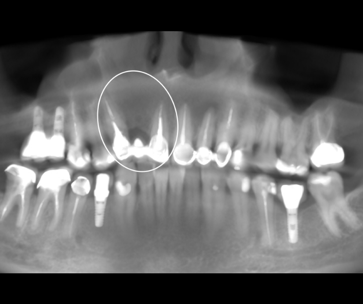 cursos de implantología dental extracción de los dientes 21, 22 y 23