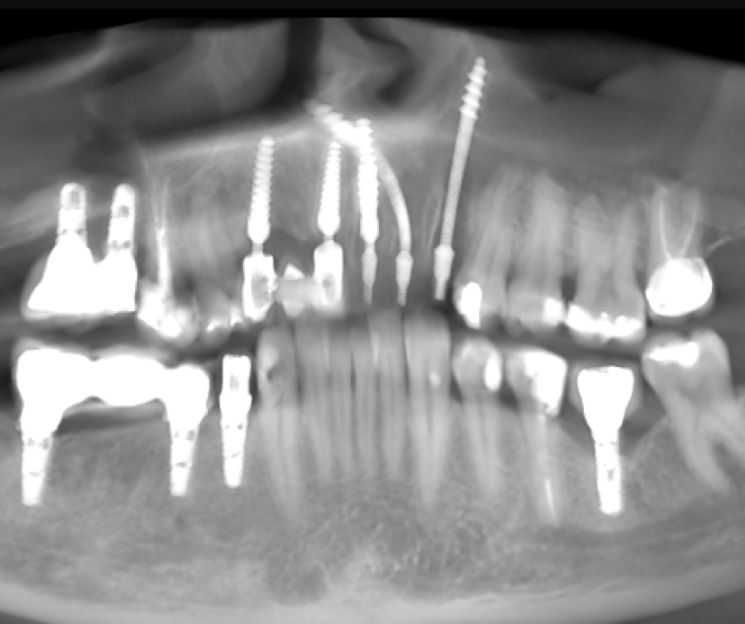 dr. francisco díez implantología dental