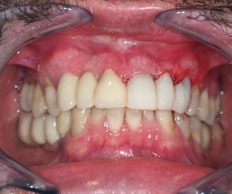 dr. francisco díez implantología y cibeles 3d