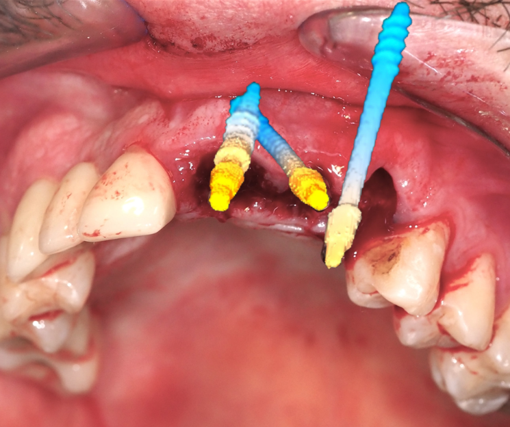 formación en implantología compresiva