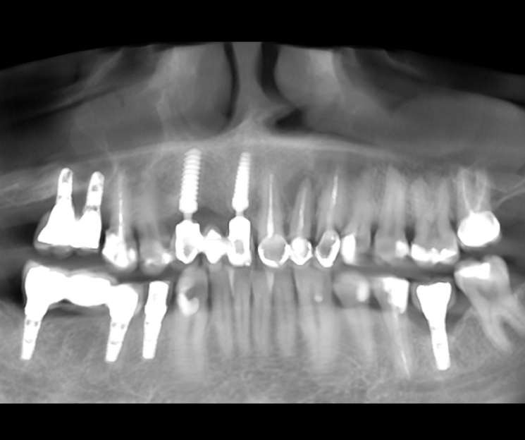implantes compresivos rehabilitación vs convencionales