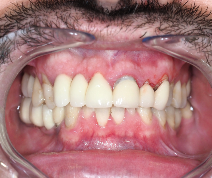 implantología córticobasal resolviendo caso