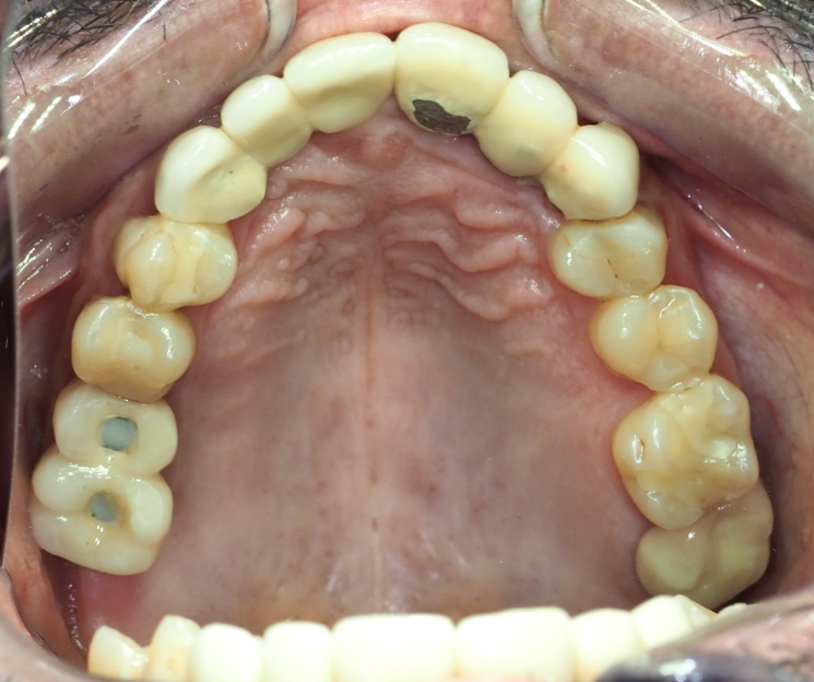 mejor curso en implantes córticobasales