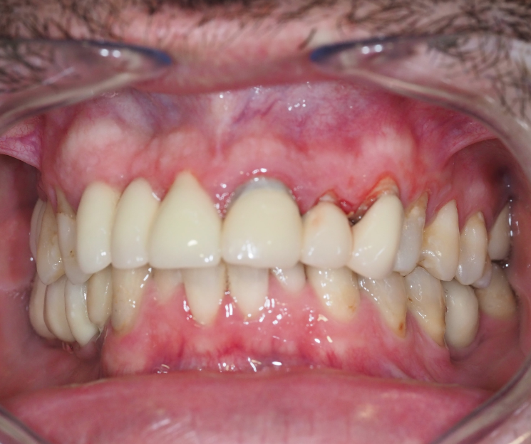 rehabilitación postextracción con implantes