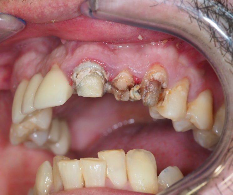 resolviendo caso dónde estudiar implantología dental en méxico