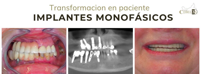 Historias que Transformamos Implantes Monofásicos