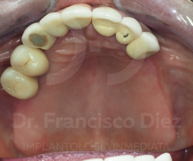 carga inmediata 24 horas curso
