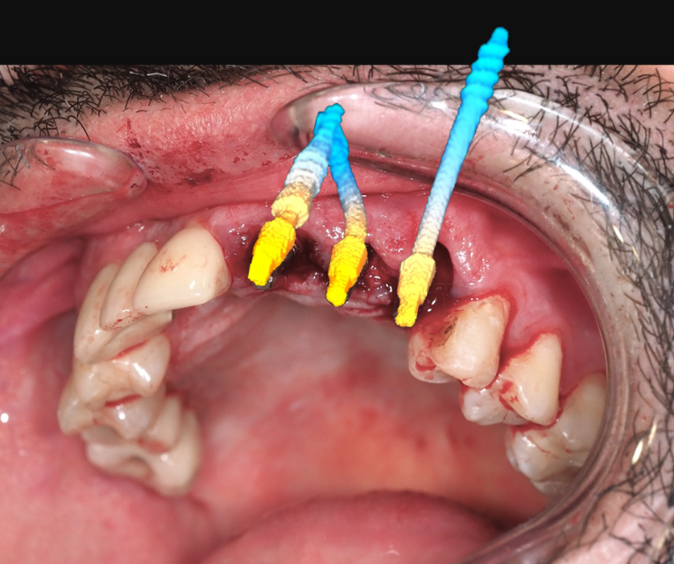carga inmediata en infección