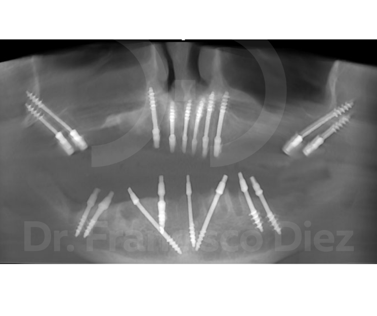 curso implantología avanzada cibeles3d