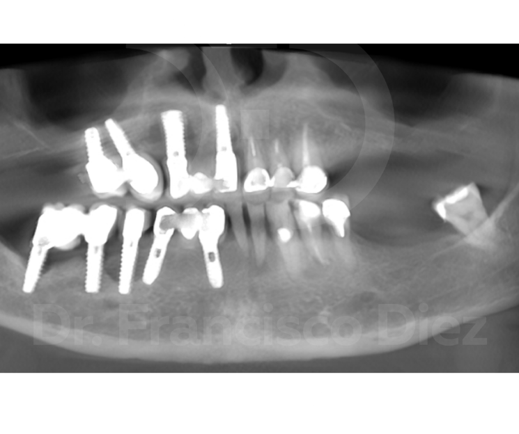 fracaso de implantes convencionales
