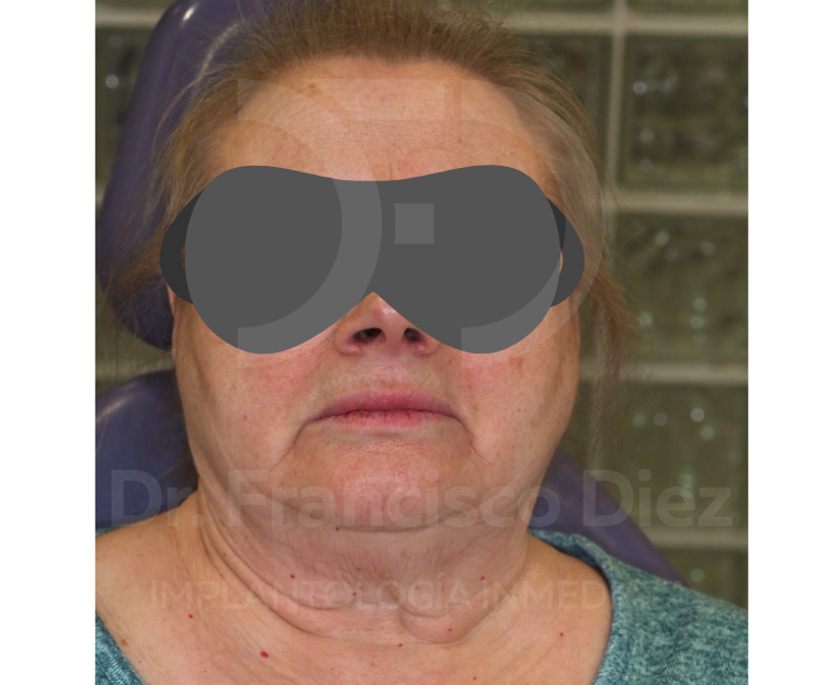 implantes monofásicos corticobasales