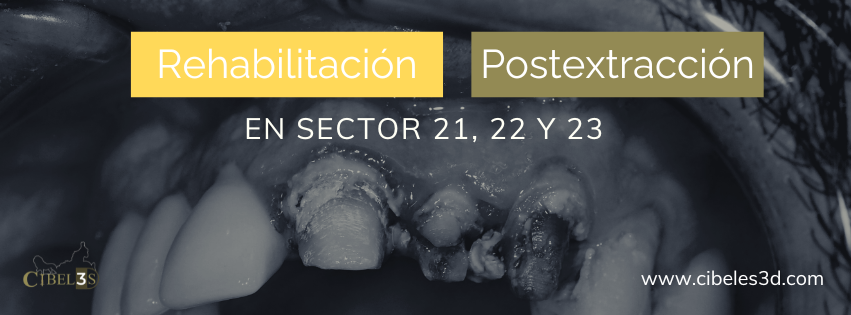 Caso Clínico: Rehabilitación postextracción en 21, 22 y 23 con implantes córticobasales