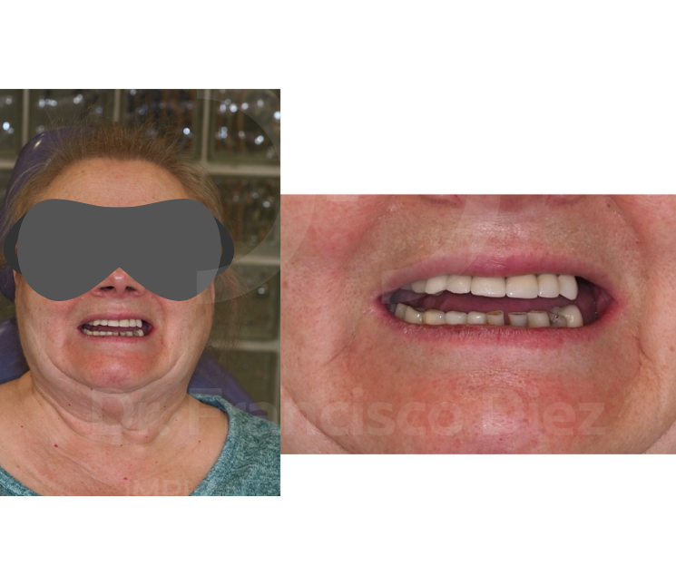 periimplantitis solución