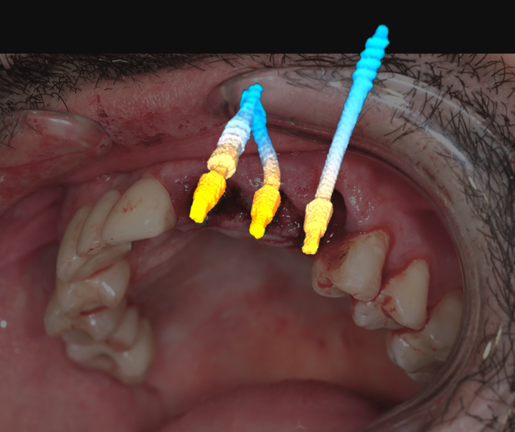 rehabilitación postextracción, dr. francisco diez